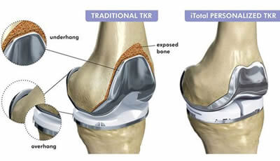 Comparaison entre prothèse du genou, standard et sur mesure