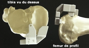 Guides sur mesure posés sur le tibia et le fémur