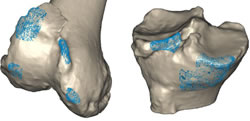 Les aspérités de la surface osseuse sont repérées sur la reconstruction 3D à partir du scanner