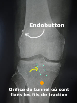 radiographie post-opératoire d'une ligamentoplastie du ligament croisé antérieur