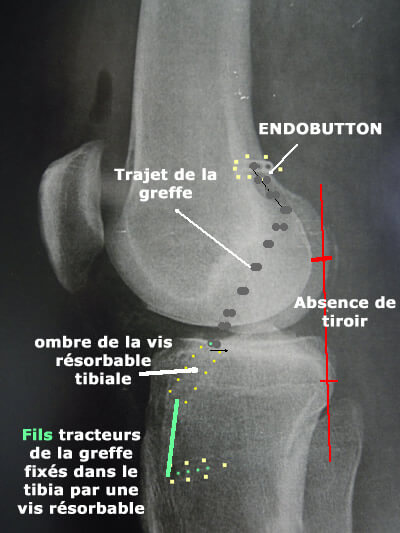 radio de profil du genou après ligamentoplastie 