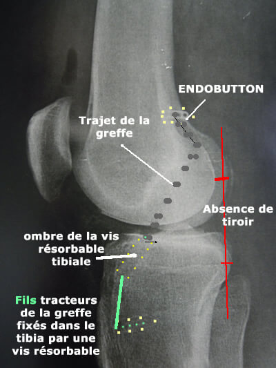 radio de profil du genou après ligamentoplastie