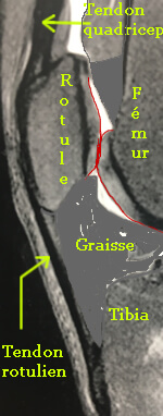 Le tendon du quadriceps s'attache sur la rotule, reliée au tibia par le tendon rotulien.