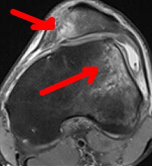 Image irm de la contusion du fémur provoquée par la luxation de la rotule