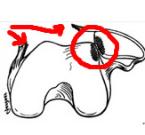 Dessin du choc cartilagineux lors de la luxation de rotule