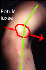 Photo d'un genou avec sa rotule