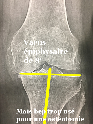 Radio montrant un varus épiphysaire de 8 degrés