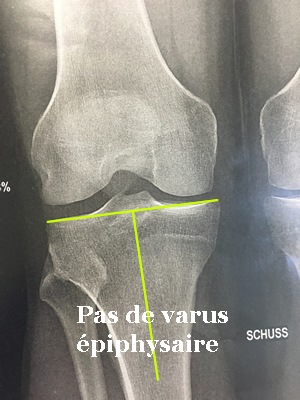 Radio montrant l'absence de varus épiphysaire